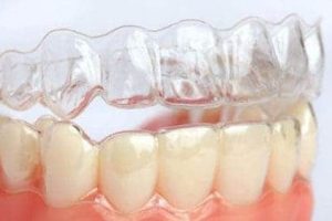 Aparelho dental Invisalign em Guaratinguetá